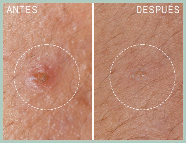 LIERAC PROTOCOLO ANTIIMPERFECCIONES STOP GRANOS 15ml - Imagen 3